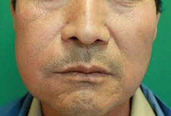 Diş İltihabı Yanak Şişmesi Belirtileri ve Tedavisi