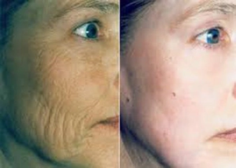 Yanak Kırışıklıkları Nasıl Giderilir?